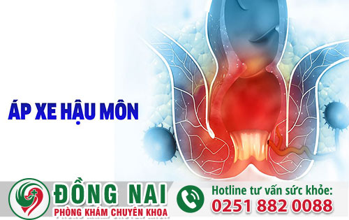 Apxe hậu môn có thể khắc phục hay không và ở đâu tốt
