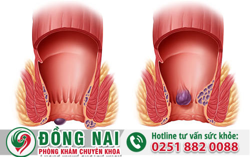 Bạn có thể tự hỗ trợ khắc phục bệnh trĩ bằng cách nào?