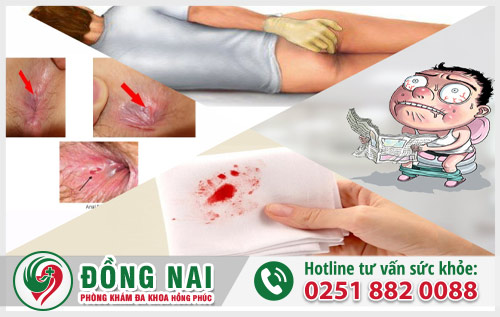 Dấu hiệu nứt kẽ hậu môn