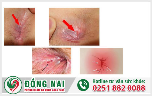 Bệnh trực tràng hậu môn thường gặp và những tác hại nguy hiểm