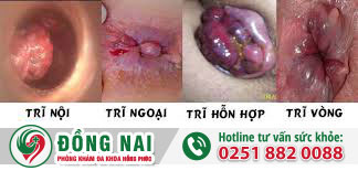 Bệnh trực tràng hậu môn thường gặp và những tác hại nguy hiểm