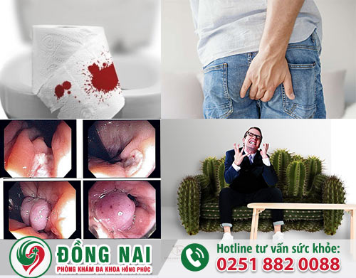 Lòi dom là bệnh gì? Cách chữa hiệu quả nhanh hết
