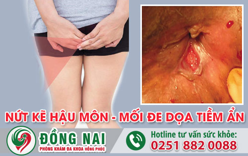 Nứt kẽ hậu môn là bệnh lý nguy hiểm cần được điều trị sớm