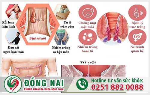 Bệnh Trĩ Có Nguy Hiểm Không?Trĩ Có Mấy Loại Và Có Thể Trị Dứt Trĩ Không?