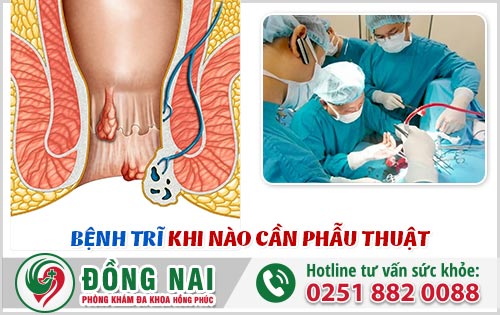 Bệnh trĩ khi nào cần phẫu thuật?