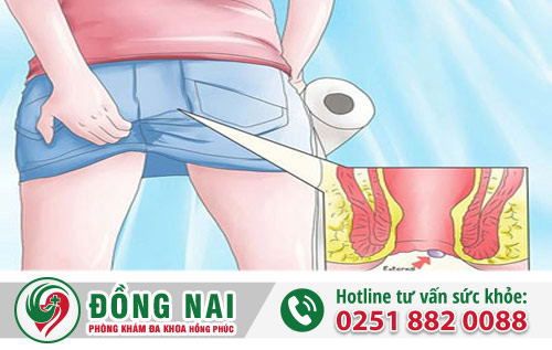 Trĩ ngoại có phải là một căn bệnh nguy hiểm?