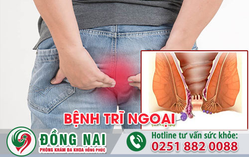 Bệnh trĩ ngoại là gì?