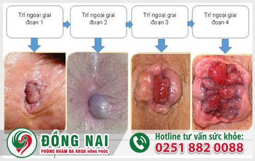 Dấu hiệu nhận biết bệnh trĩ ngoại