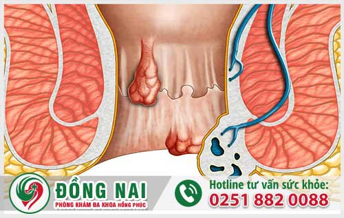 Bị Bệnh Trĩ Mức Độ 2 Và Mức Độ 3 Nguy Hiểm Như Thế Nào?