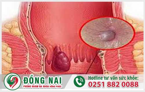 Bị Lòi Trĩ Là Như Thế Nào? Nguyên Nhân Do Đâu Gây Nên Bệnh Trĩ?