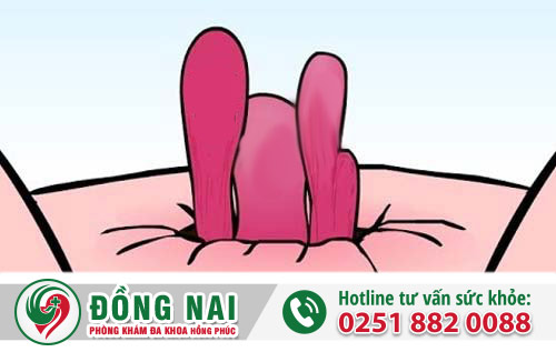 Bị nổi mụn ở hậu môn là bệnh gì?