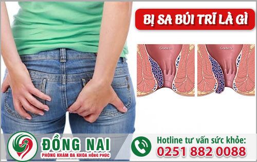 Bị sa búi trĩ là gì? Cách điều trị nhanh chóng và dứt bệnh không tái phát