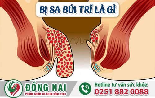 Bị sa búi trĩ là gì? Cách điều trị nhanh chóng và dứt bệnh không tái phát