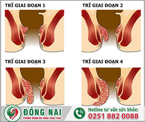 Các giai đoạn bệnh trĩ và cách chữa hiệu quả