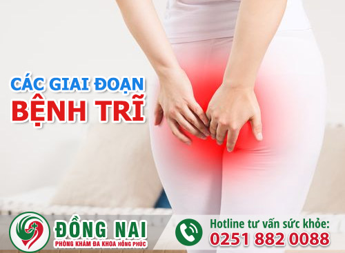 Các giai đoạn bệnh trĩ và cách chữa hiệu quả