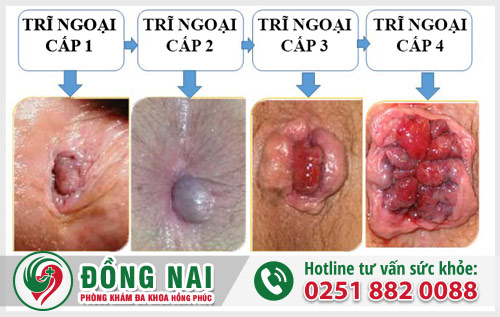 Các giai đoạn của bệnh trĩ