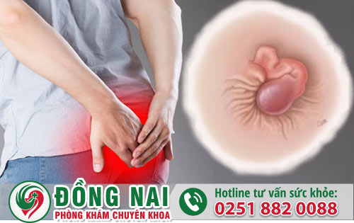 Các giai đoạn trĩ ngoại và cách diều trị