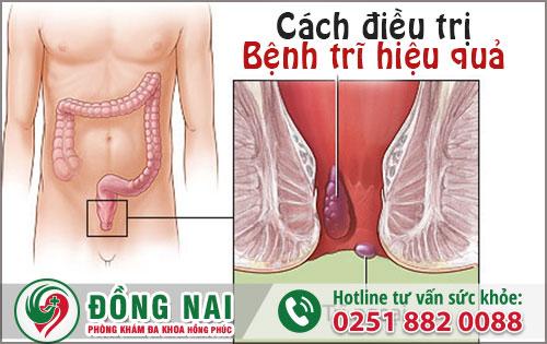 Bệnh trĩ và cách điều trị hiệu quả hiện nay tại Phòng Khám Biên Hòa Đồng Nai