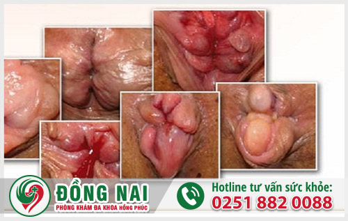 Cách điều trị lòi trĩ hiệu quả tốt