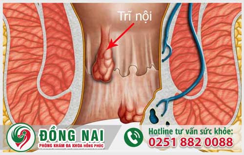 Cách Nhận Biết Bạn Có Đang Bị Bệnh Trĩ Hay Không?Bệnh Trĩ Có Nguy Hiểm Không?