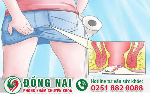 Cần làm gì khi xuất hiện cục thịt thừa hậu môn và nó nuy hiểm không?
