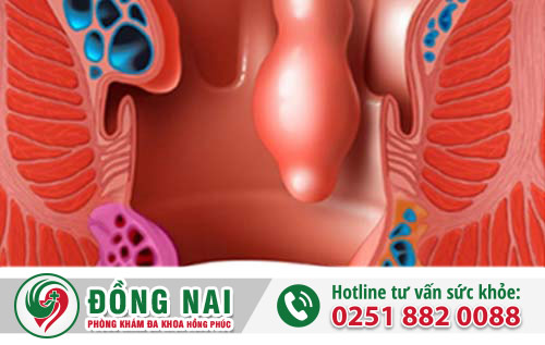 Chi phí cắt trĩ là bao nhiêu?