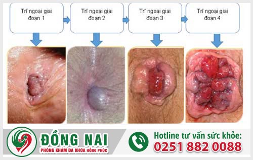 Cục thịt thừa ở hậu môn là bệnh gì? Có gây nguy hiểm gì không? Cách chữa và điều trị ra sao?
