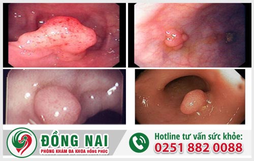 Cục thịt thừa ở hậu môn là bệnh gì? Có gây nguy hiểm gì không? Cách chữa và điều trị ra sao?