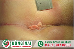 Da thừa hậu môn có tự lành không?
