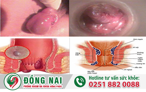 Một số biểu hiện da thừa hậu môn
