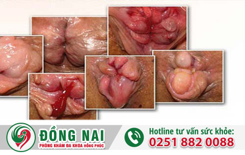Dấu hiệu của bệnh sa búi trĩ
