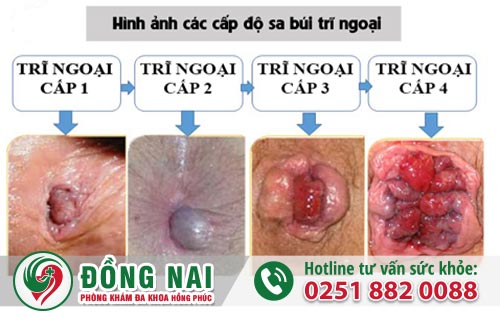 Dấu hiệu và nguy hại của bệnh trĩ
