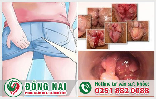 Dấu hiệu và nguy hại của bệnh trĩ