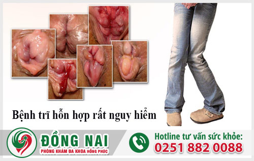Dấu hiệu và nguy hại của bệnh trĩ
