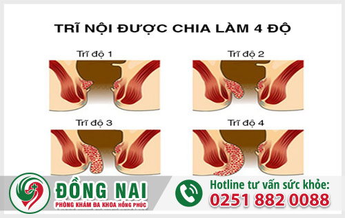 Dấu hiệu và nguy hại của bệnh trĩ