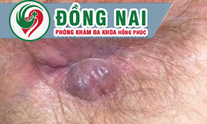 Dấu hiệu nhận biết bệnh trĩ ngoại