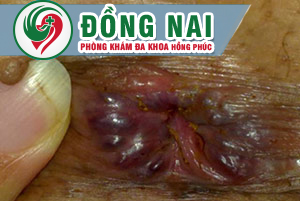 Dấu hiệu nhận biết bệnh trĩ ngoại