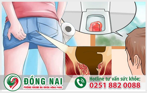 Đi cầu ra máu dấu hiệu cảnh báo nhiều bệnh lý nguy hiểm