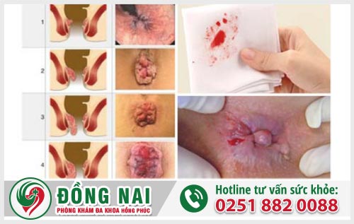 Đi cầu ra máu là bệnh gì?