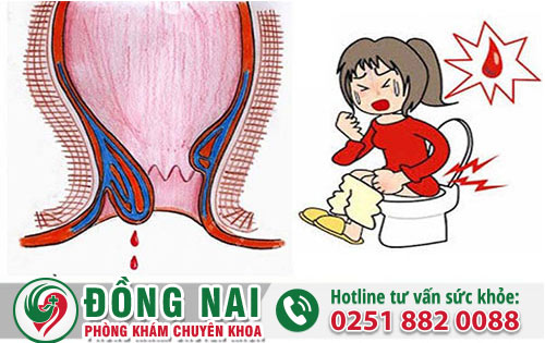 Đi cầu ra máu và đau vùng bụng dưới là bởi nguyên nhân gì?