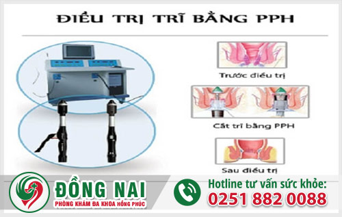 Điều trị sa búi trĩ chỉ sau một liệu trình