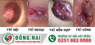 Hậu môn xuất hiện vật thể lạ là bị gì?