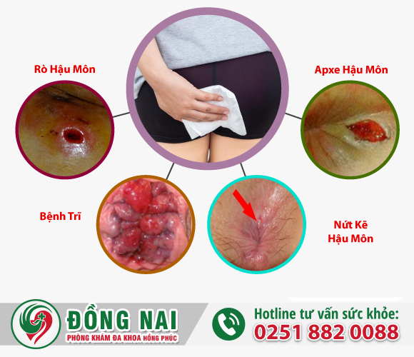 Hiện tượng đi vệ sinh ra máu tươi là bệnh gì?