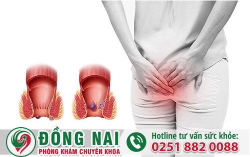 Hỗ trợ điều trị bệnh trĩ tại nhà bằng các cách thức nào hiệu quả?