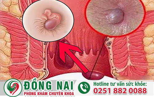 Hỗ trợ điều trị sa búi trĩ ở đâu tại Đồng Nai mang lại kết quả tốt?