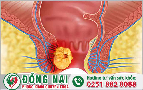 hỗ trợ khắc phục polp hậu môn ằng cách nào mang lại kết quả khả quan?