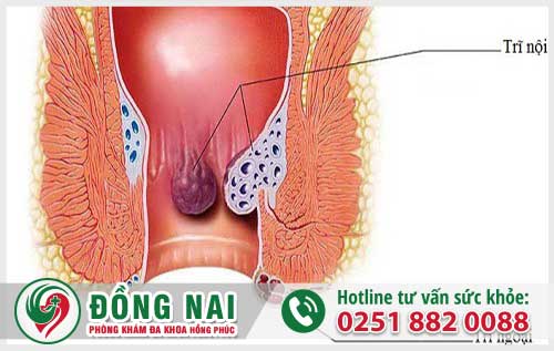 Bệnh Trĩ Có Cần Phẫu Thuật Không? Nên Hay Không Nên Phẫu Thuật