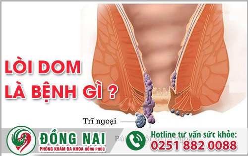 Bệnh lòi dom là gì? Nguyên nhân nào gây bệnh?