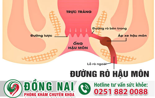 Mắc phải bệnh rò hậu môn phải áp dụng cách chữa nào hiệu quả hiện nay?