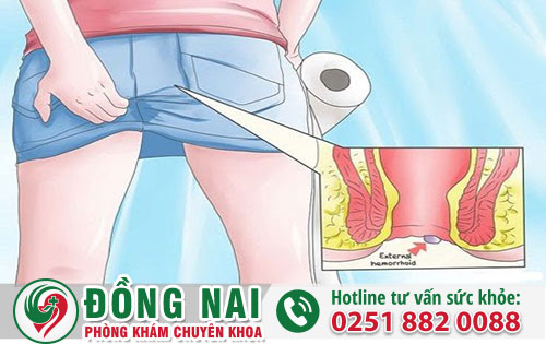 Ngứa Hậu Môn Có Phải Dấu Hiệu Bệnh Trĩ Không?
